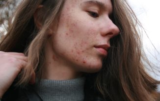 The Ultimate Acne Guide: Causes, Treatment, and How to Prevent Future Breakouts