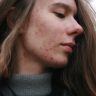 The Ultimate Acne Guide: Causes, Treatment, and How to Prevent Future Breakouts