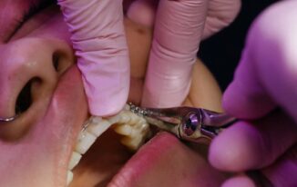 The Journey to a Healthier Smile: What to Know About Oral Surgery
