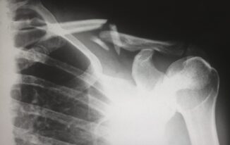 Shoulder