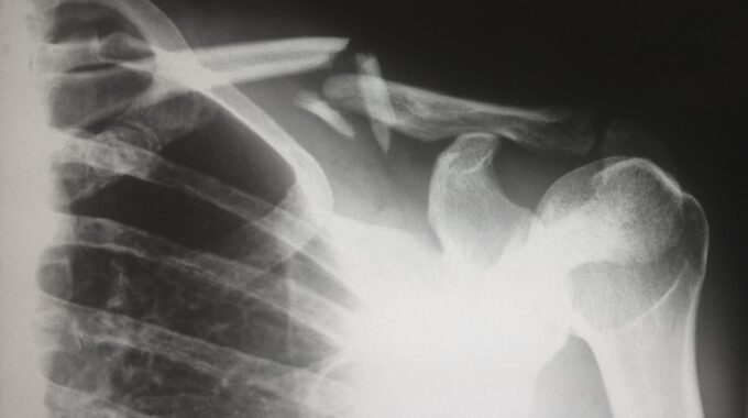 Strategies for Soothing Your Shoulder: From Gentle Care to Advanced Therapies