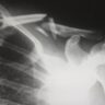 Strategies for Soothing Your Shoulder: From Gentle Care to Advanced Therapies