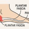 Effective Strategies for Managing Plantar Fasciitis